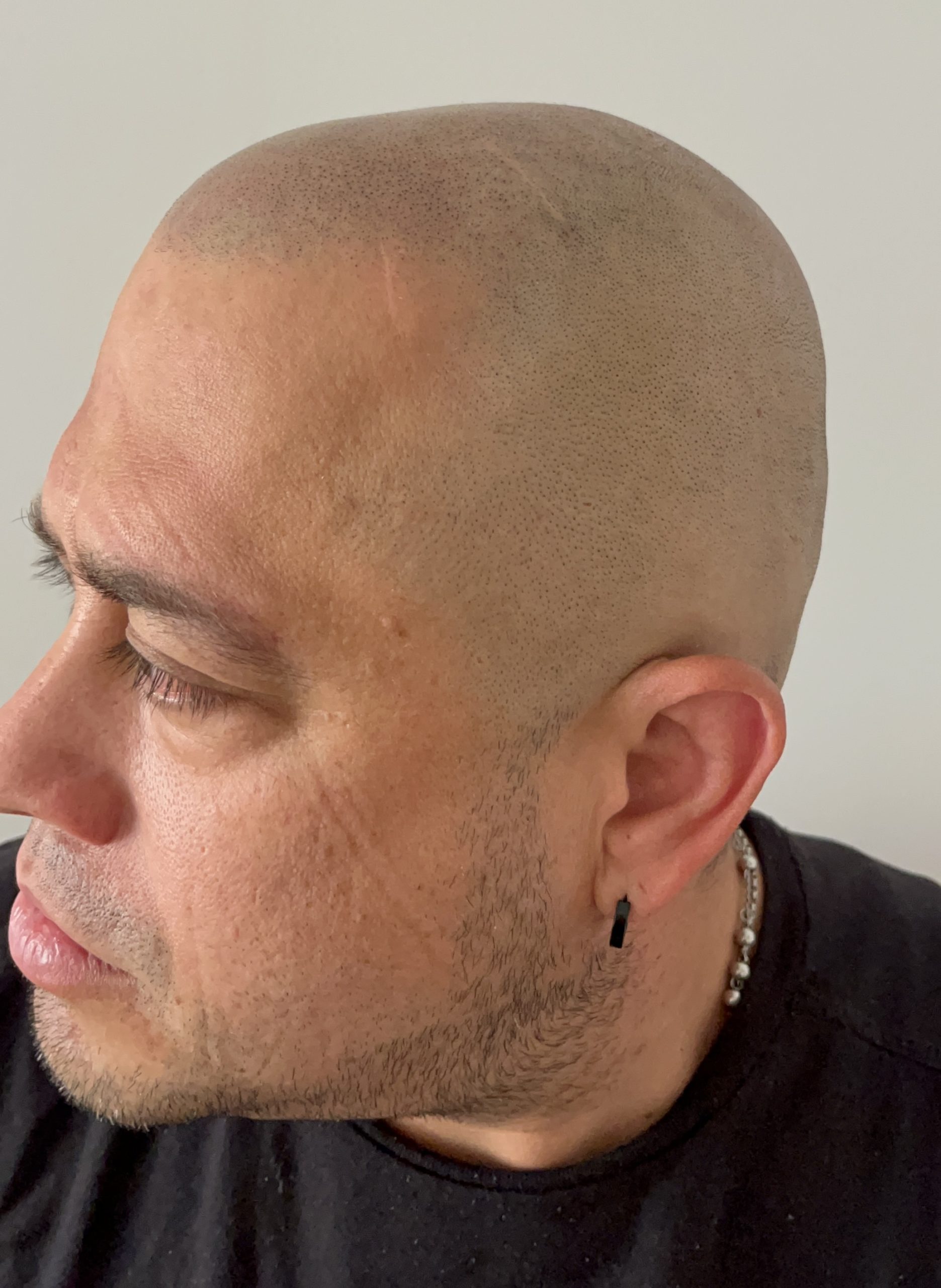 Clientes satisfechos con micropigmentación capilar en The LeveL Capilar